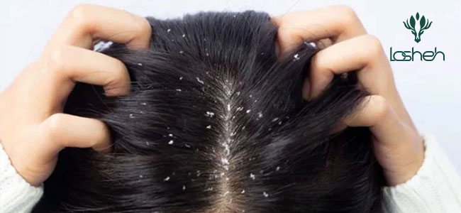 شامپو ضد شوره